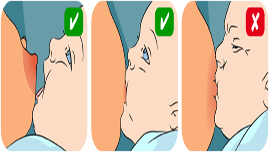 Right Positioning of Breast Feeding FOR Teenage Mother